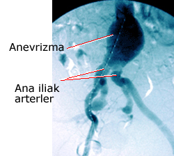 Abdominal aort anevrizması